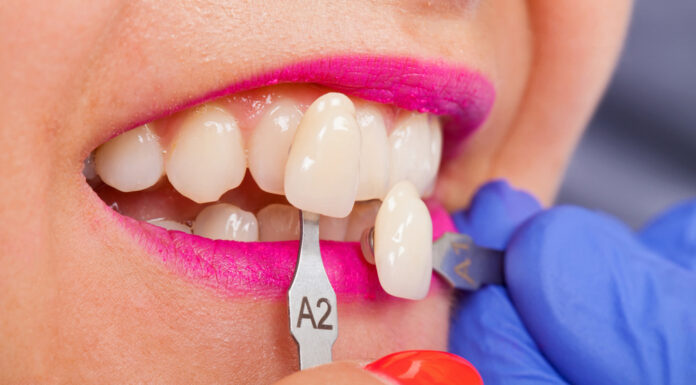 Melhor tratamento estético dentário: facetas de resina ou lentes de contato? Dentista explica