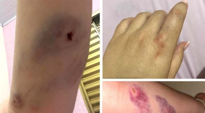 Mãe e filha sofrem ferimentos provocados por pit bull em Bastos