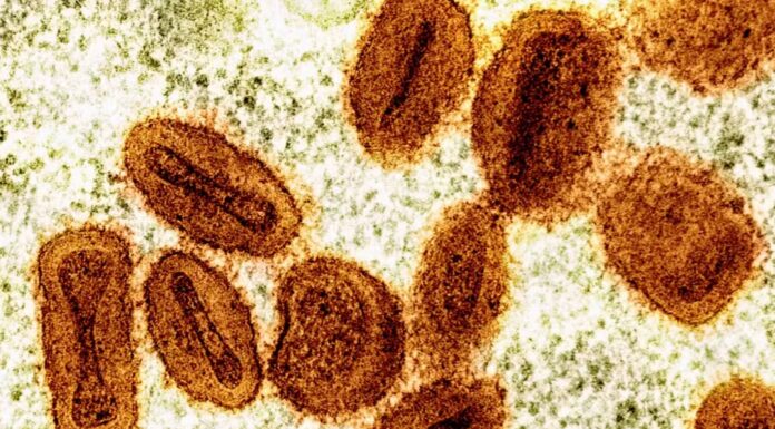 Instituto Adolfo Lutz descarta caso suspeito de monkeypox e indica que paciente teve catapora em Presidente Prudente
