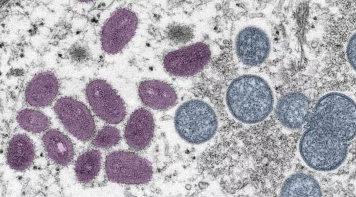 Grupo de Vigilância Epidemiológica confirma primeiro caso positivo de monkeypox em Presidente Prudente