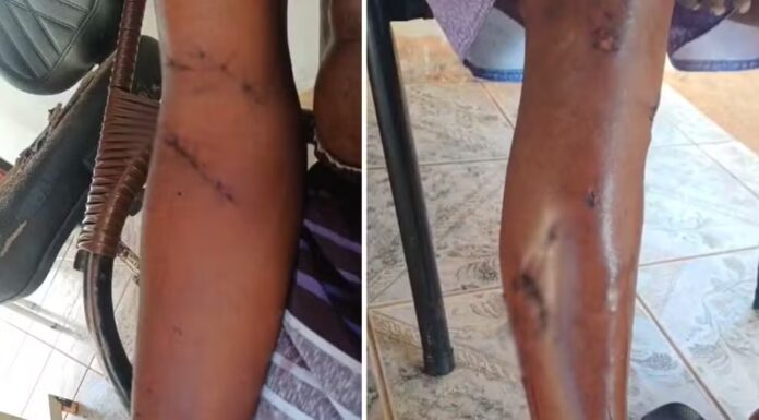 Homem de 61 anos é atacado por pitbull e fica ferido em Tarabai