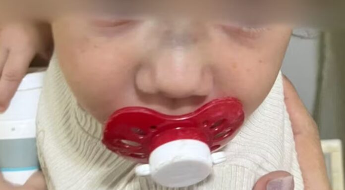 Bebê de 1 ano volta da creche com hematomas e fratura no nariz