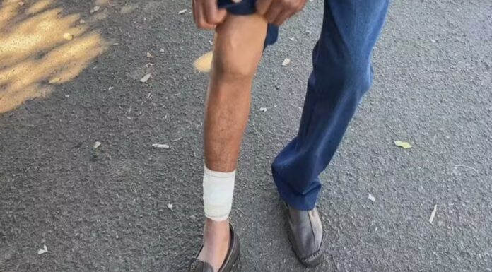 Idoso tem braço amputado e homem fica ferido após ataque de pitbull no interior de SP